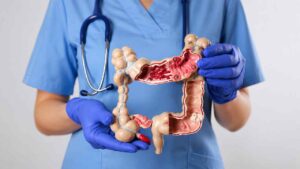 Awalnya Dikira Sakit Perut Biasa, Dokter Temukan Kanker Usus Langka pada Lansia